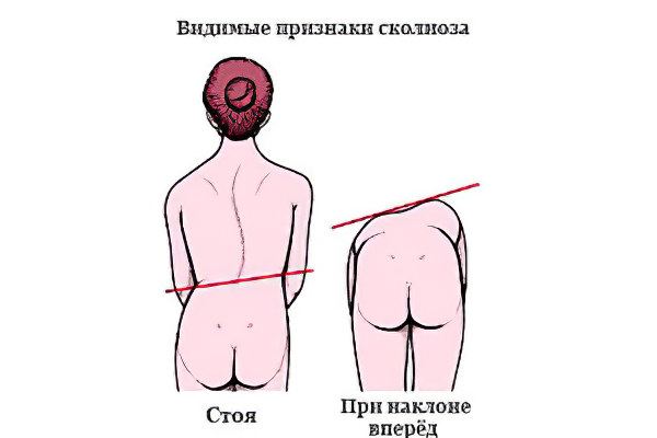 Виды сколиоза 2 степени