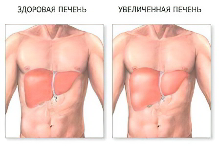 Увеличена печень