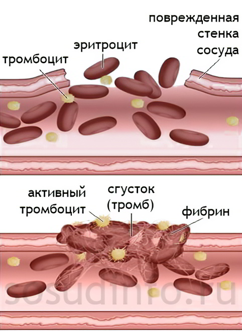 Двс синдром в акушерстве и гинекологии thumbnail