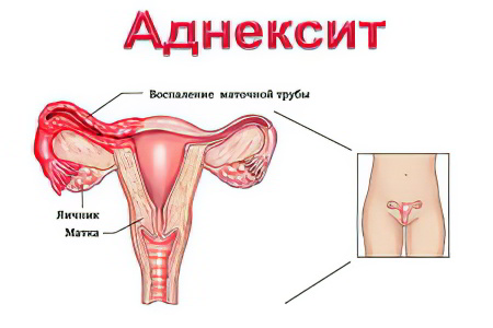 Аднексит