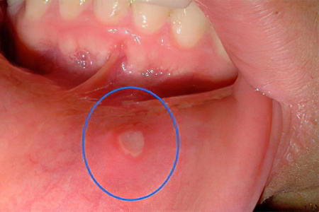 Что делать при афтозном стоматите