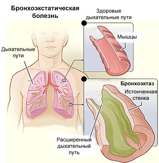 Поражение дыхательной системы