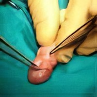 Киста крайней плоти лечение народными средствами