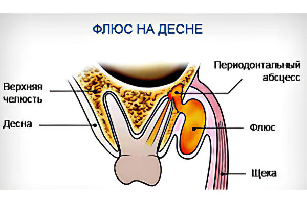 Флюс на десне