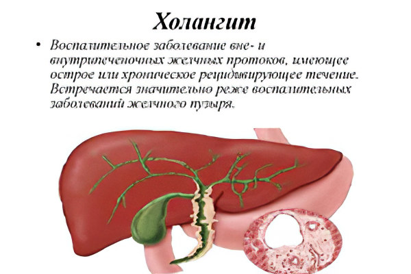 Холангит