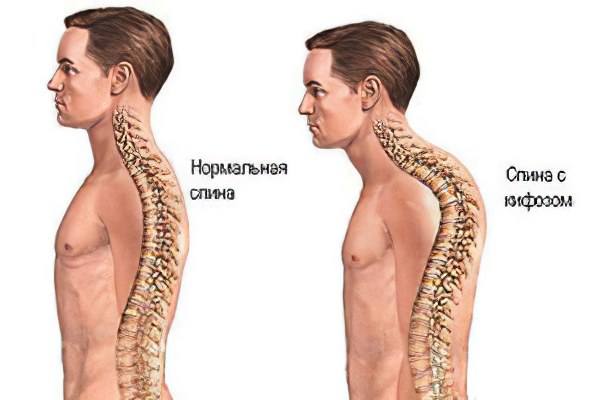 Кифоз грудного отдела