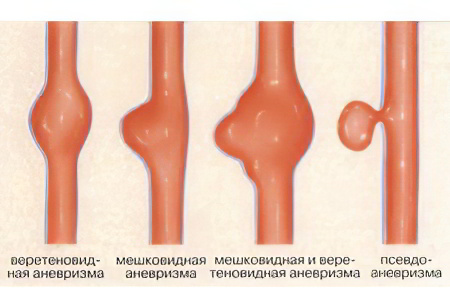 Аневризме аорте болит поясница