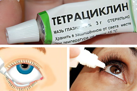 Лечение ячменя