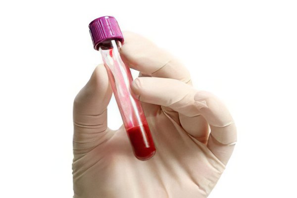 Биохимический анализ крови норма и расшифровка результатов алт thumbnail
