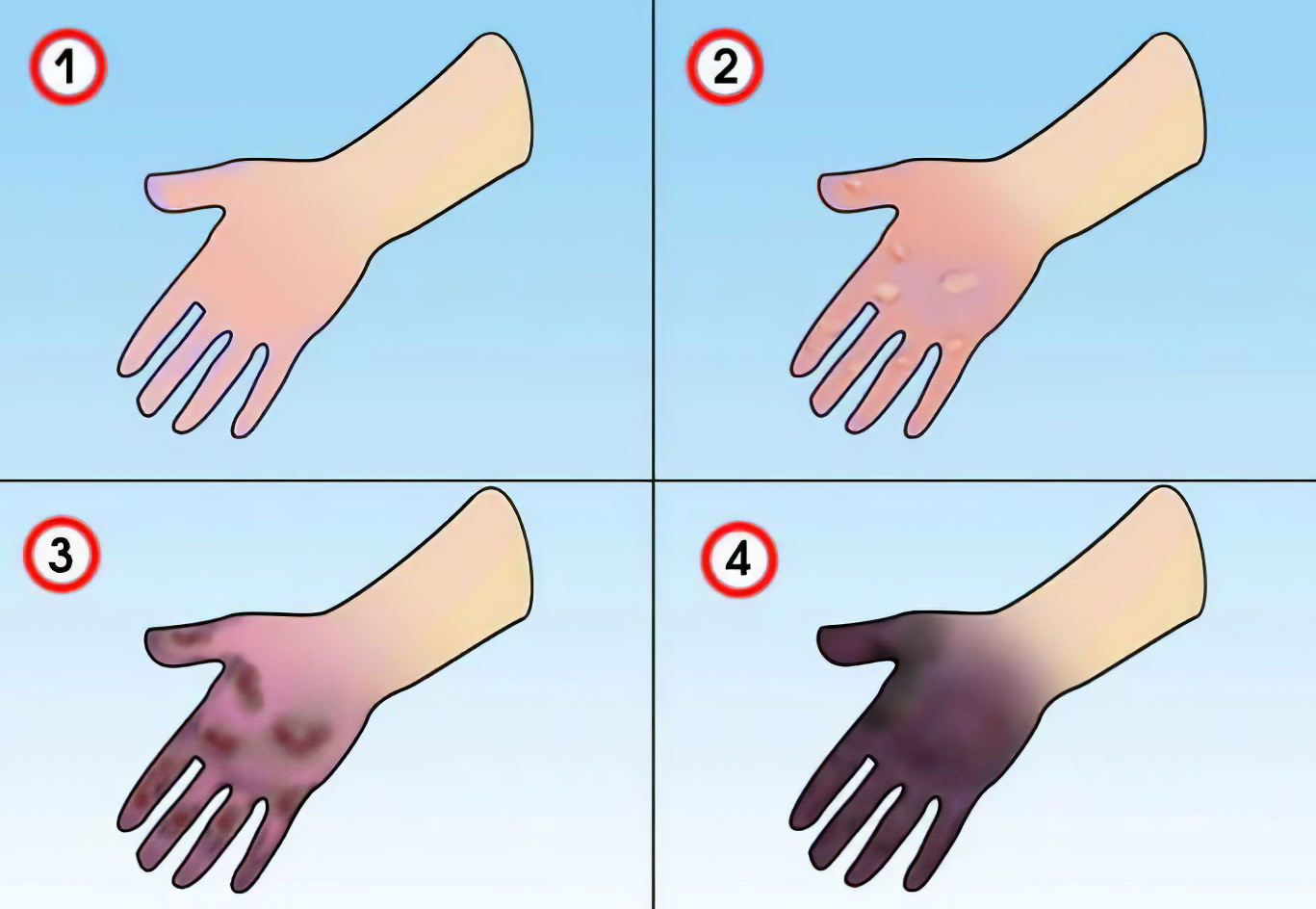 Отморожение и обморожение это одно и тоже Отморожение и обморожение это одно и тоже thumbnail