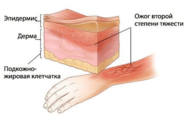 Ожог 2 степени