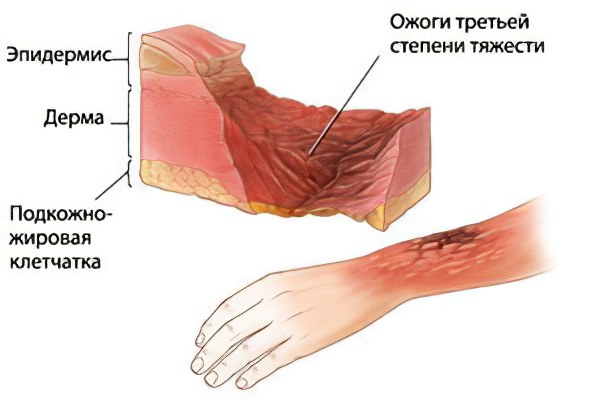 Ожог 3 степени