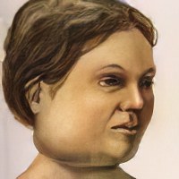 Эпидемический паротит лечение народными средствами