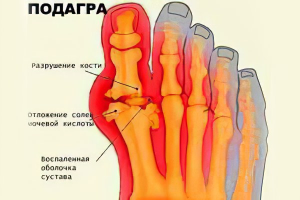 Как проявляется подагра коленного сустава
