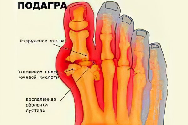 Боль в ступне при подагре чем лечить