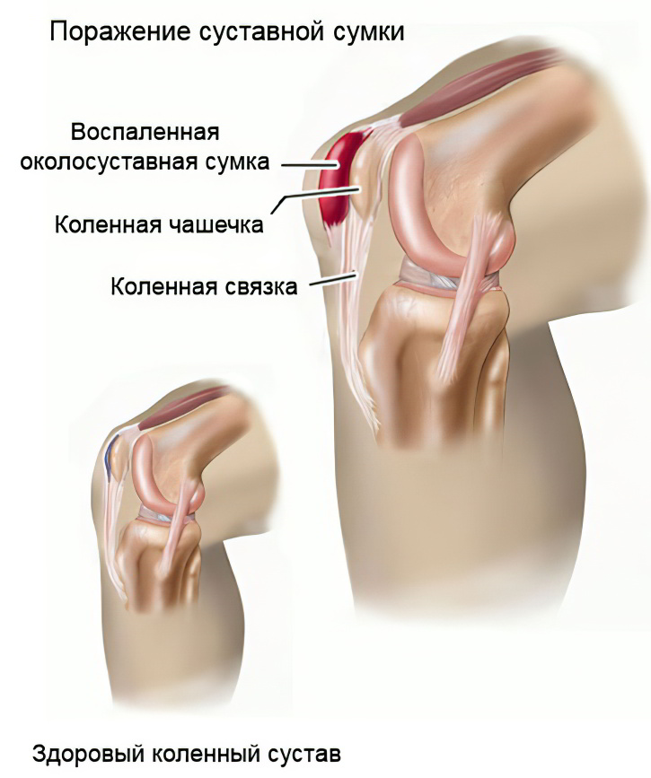 Заболевания суставов