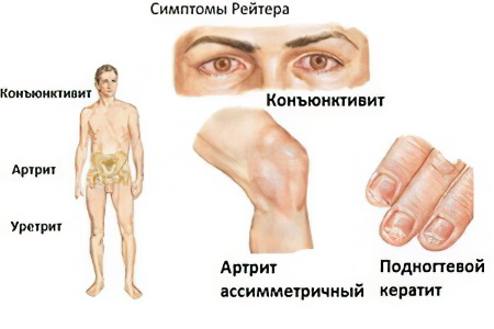 Синдром рейтера симптомы у детей thumbnail