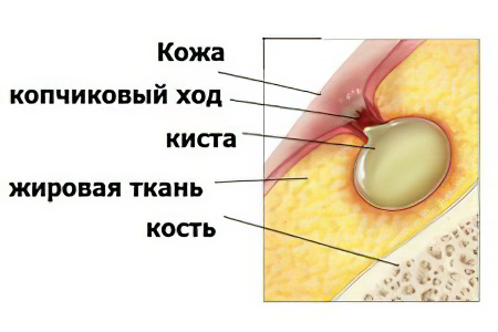 Строение свища