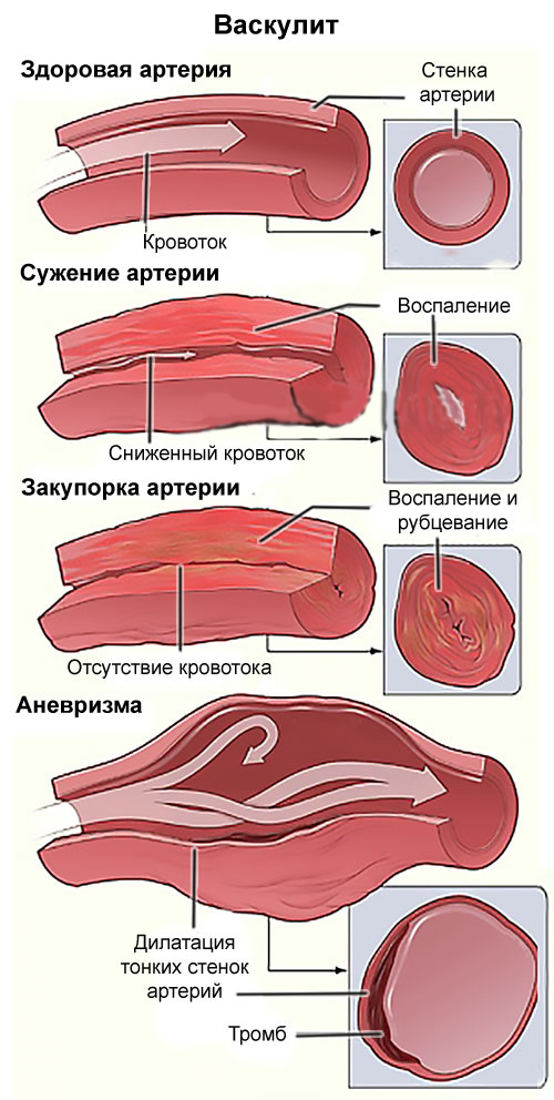 Васкулит