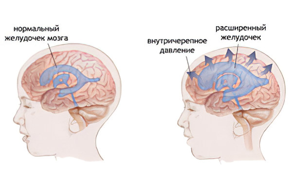 внутричерепного давления