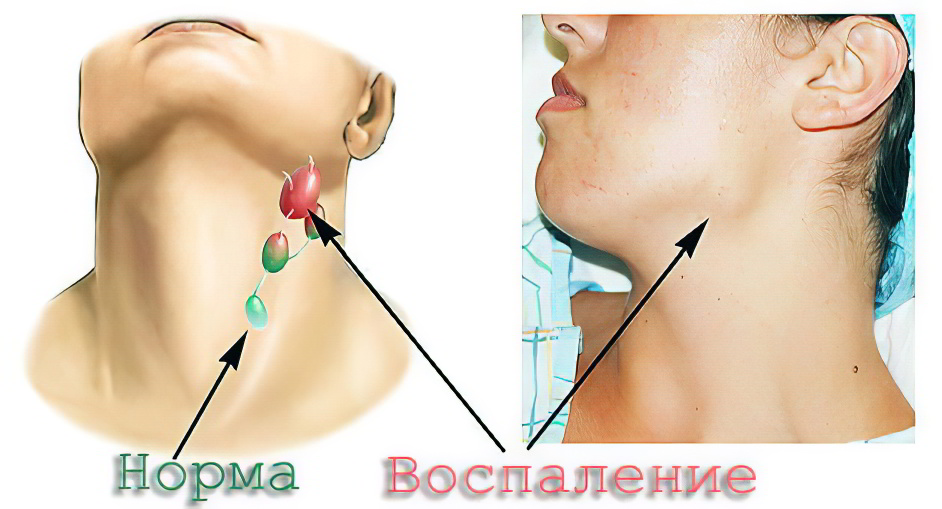 Лимфаденит