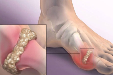 Подагра на ступнях ног симптомы и лечение