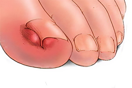 Ноготь большего пальца на ноге врос в кожу thumbnail