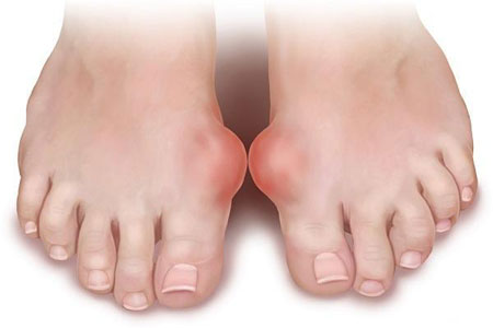Подагра на ступнях ног симптомы и лечение
