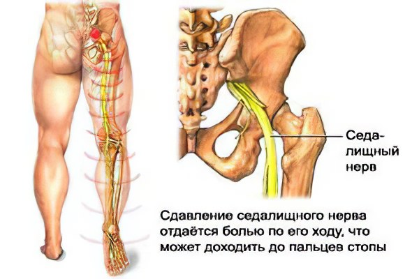 Ходьба при защемлении нерва thumbnail