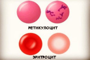 Ретикулоцитоз при анемии это thumbnail