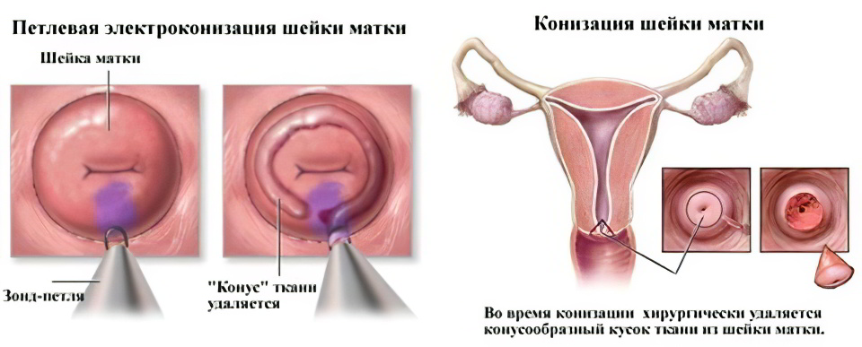 Электроконизация шейки матки при дисплазии 3 степени 27