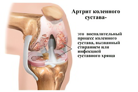 артрит коленного сустава