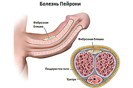 Болезнь Пейрони