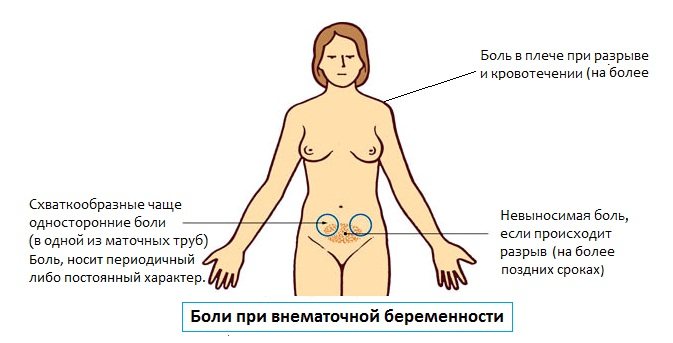 Виды боли при внематочной беременности