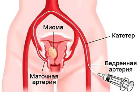 2 современных метода лечения миомы матки без операции