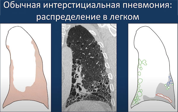 Интерстициальная пневмония