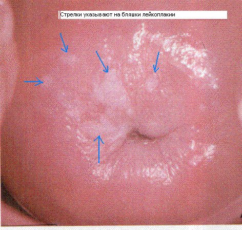 Лейкоплакия