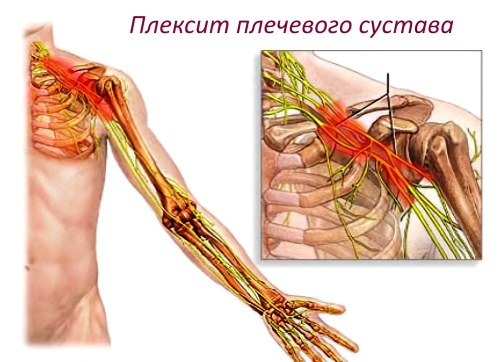 Плечевой плексит