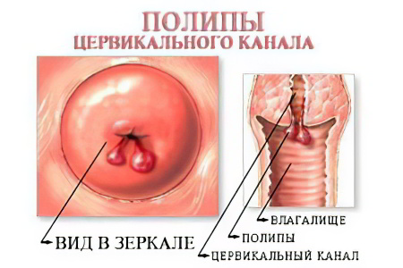 полип цервикального канала