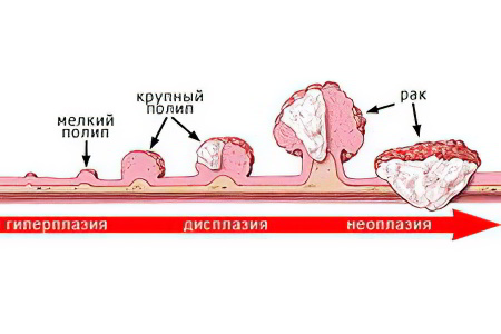 удаление полипов в прямой кишке