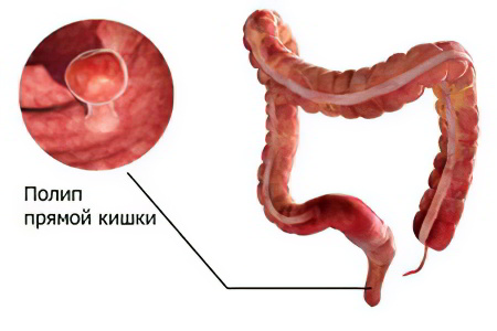 удаление полипов в прямой кишке