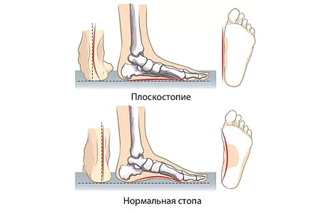Плоскостопие