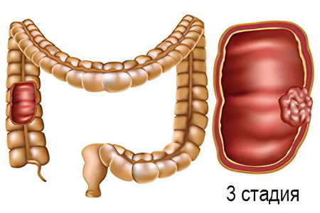 3 стадия