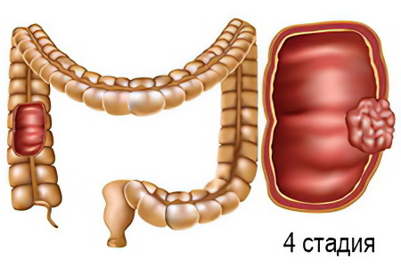 4 стадия