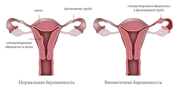 Нормальная и внематочная беременность