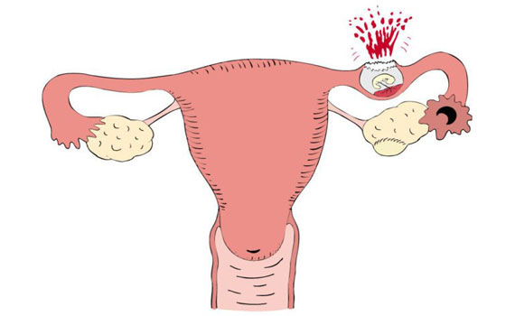 Последствия внематочной беременности