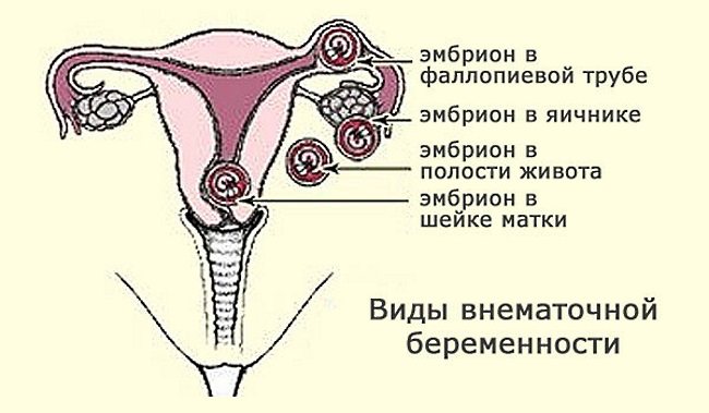 Виды внематочной беременности