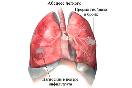 Абсцесс лёгкого