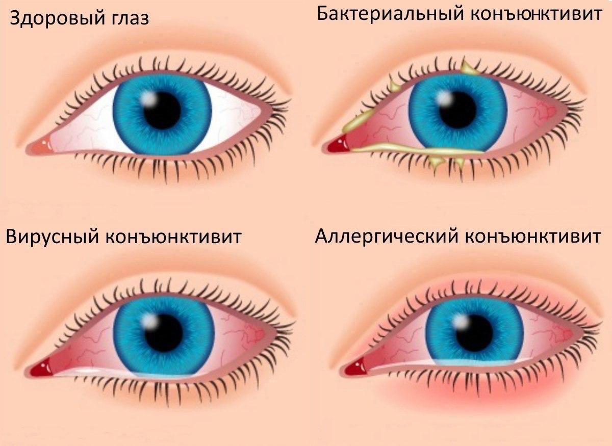 Аденовирусный конъюнктивит глаз