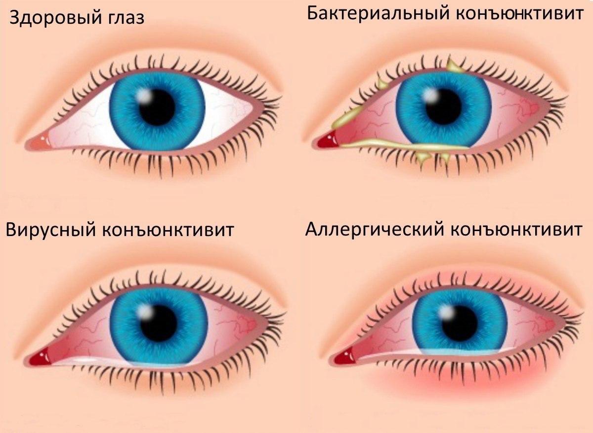 Для лечения заболевания глаз применяют 0.5. Аденовирусная инфекция бактериальный конъюнктивит. Аденовирусный конъюнктивит глаз. Бактериальный конъюнктивит Гнойный. Герпетический вирусный конъюнктивит.